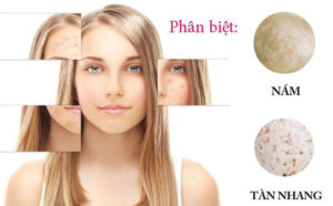 Cách Trị Nám Tàn Nhang Lâu Năm Hiệu Quả: Bí Quyết Từ Chuyên Gia