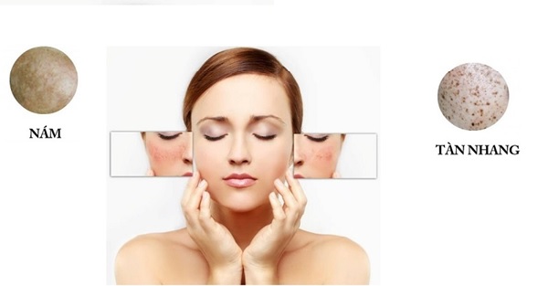 Cách Trị Nám Tàn Nhang Lâu Năm Hiệu Quả: Bí Quyết Từ Chuyên Gia